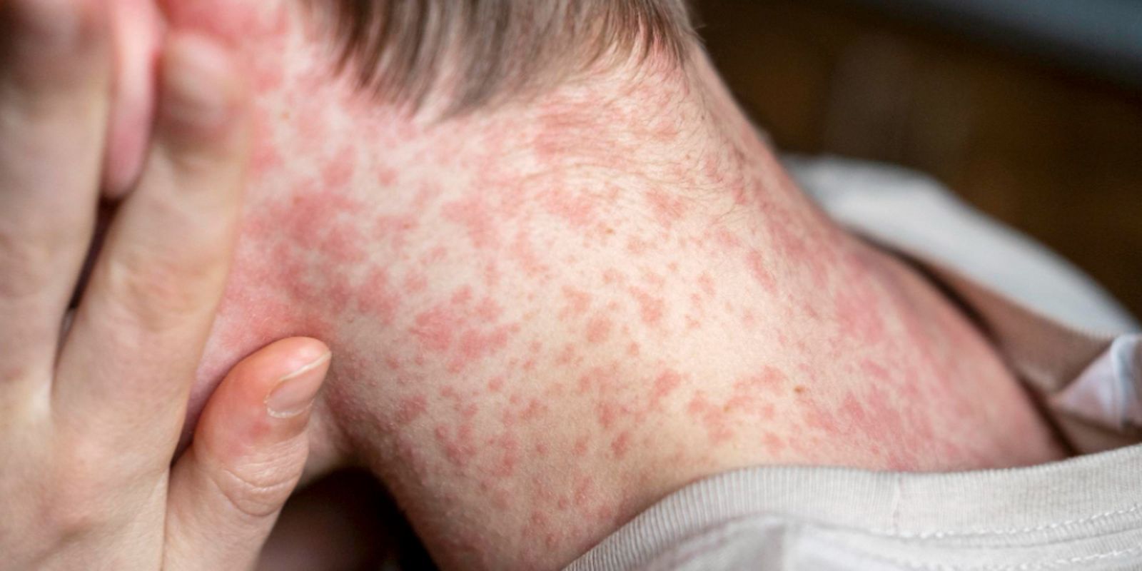 Sarampo em alerta: entenda os riscos, sintomas e a importância da vacinação no Brasil