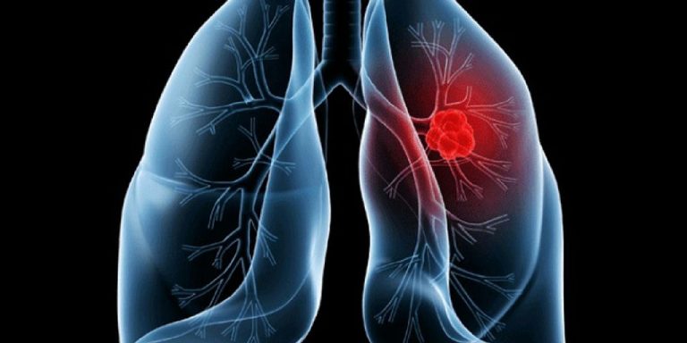 Entenda o adenocarcinoma pulmonar, diagnóstico que levou o papa Leão XIV à cirurgia